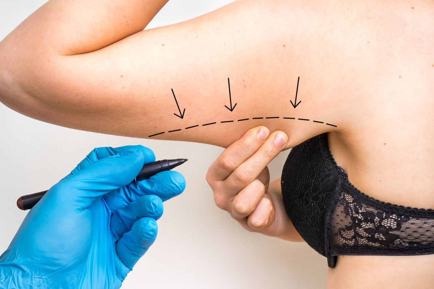Arm Contouring
