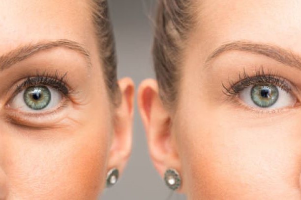 Blepharoplasty