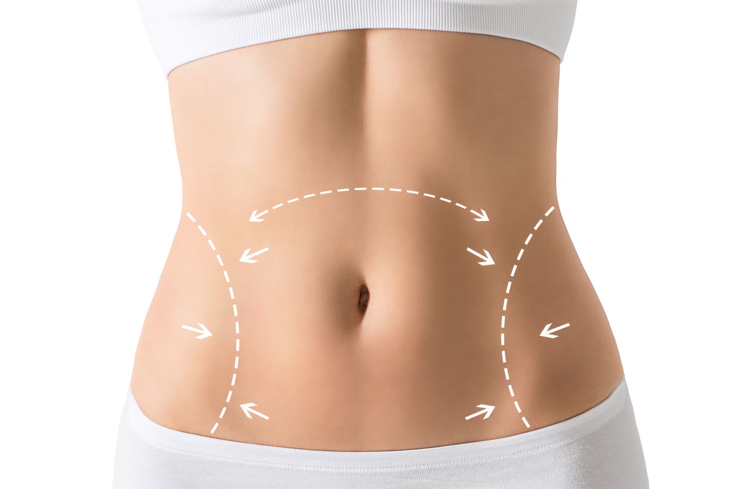 Tummy Tuck